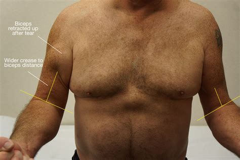 bicep muscle tear test|biceps tendon tear at shoulder.